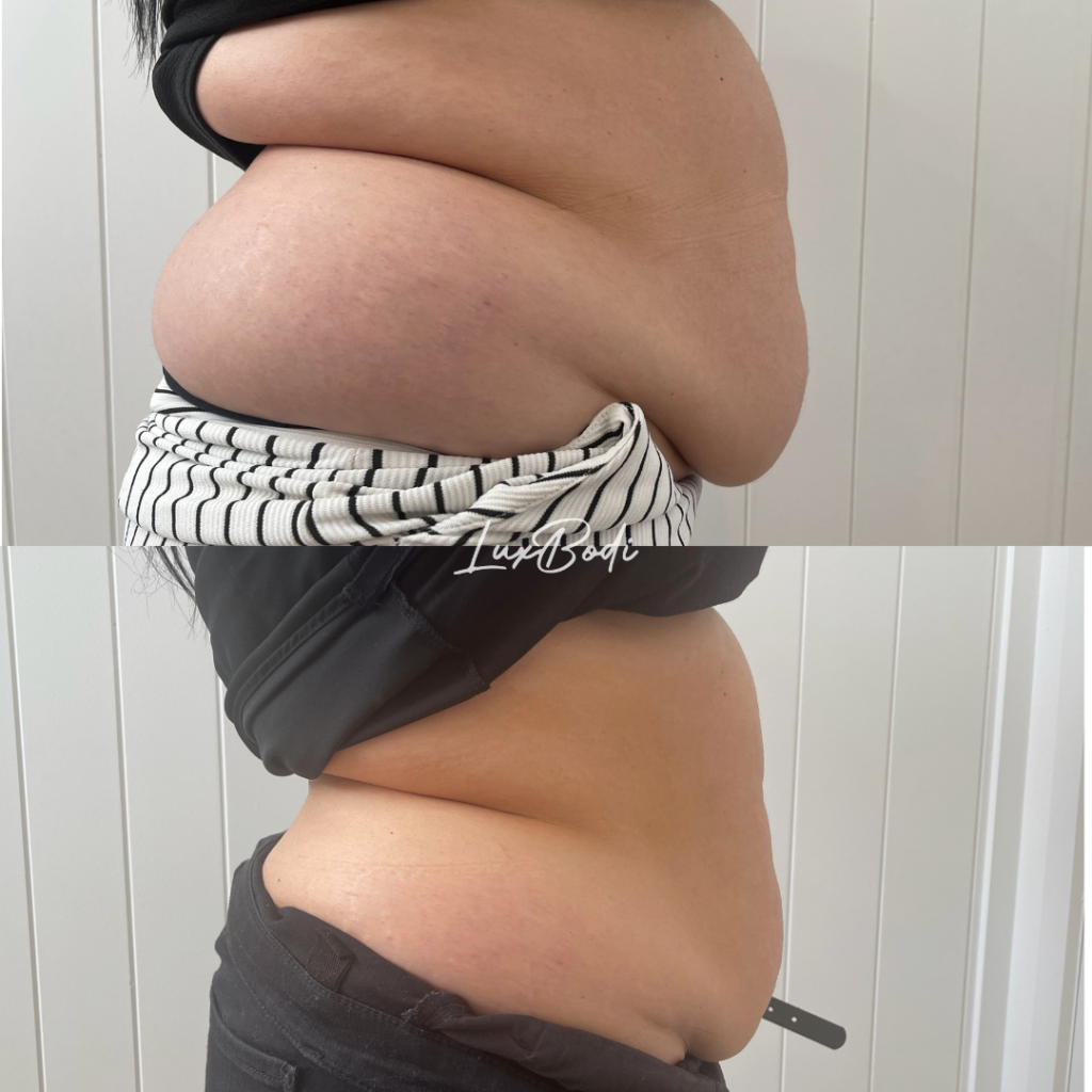 Fat Cavitation